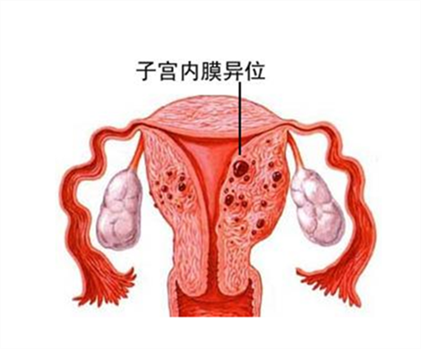 子宫内膜易位去做泰国试管婴儿困难吗？