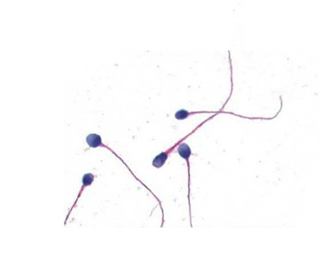 试管婴儿：精子的形态会影响受孕率吗？