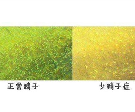 少精症是怎么造成了试管患者不育？