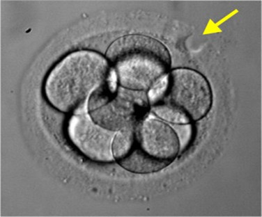 为什么有的试管夫妇需要用到辅助孵化Assisted Hatching (AH)?