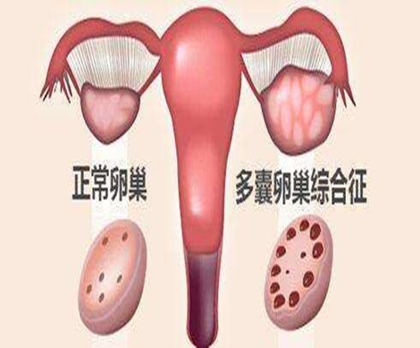 多囊卵巢做泰国试管婴儿前需要如何调理？