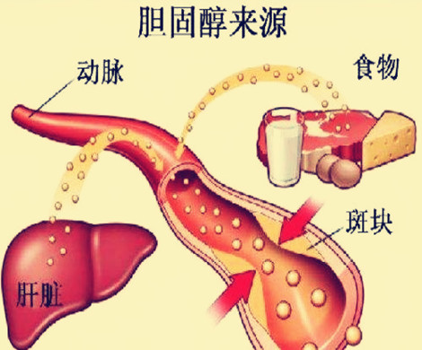 胆固醇影响怀孕?试管备孕阶段该怎样降低坏胆固醇含量？