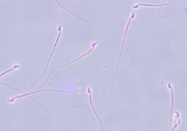 死精子症、无精子症可以做泰国试管婴儿吗